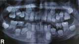 Ακτινογραφική εικόνα μικτής οδοντοφυία ( ύπαρξη ταυτόχρονα μόνιμων και παιδικών δοντιών στο στόμα) σε παιδιά ηλικίας 6 με 12 ετών. 